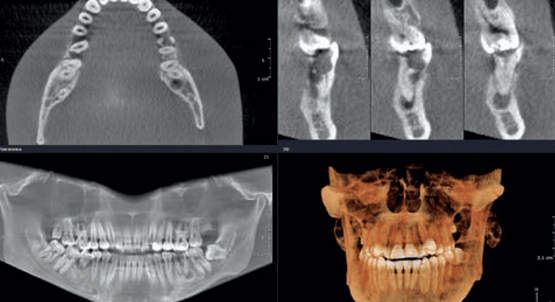 Tomografia 3d